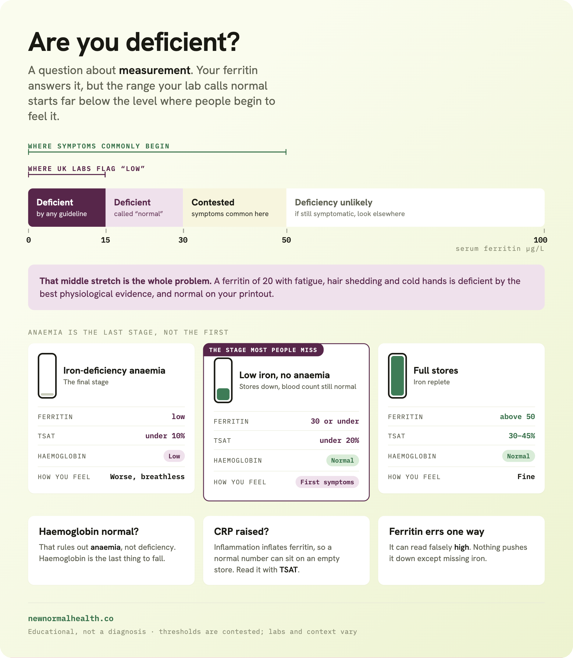 Question 1 of 3: are you deficient? A ferritin scale from 0 to 100 micrograms per litre. UK labs flag low only below about 15, while symptoms commonly begin anywhere below 50. Below 15 is deficient by any guideline. From 15 to 30 you are deficient by physiological evidence but your printout says normal. From 30 to 50 is contested, and symptoms are common there. Above 50 deficiency is unlikely. Three caveats: a normal haemoglobin rules out anaemia, not deficiency, because haemoglobin falls last; a raised CRP inflates ferritin so a normal number can sit on an empty store; and ferritin only ever errs high, because nothing pushes it down except missing iron.